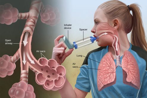 درمان بیماری آسم
