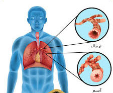روش درمان آسم عصبی