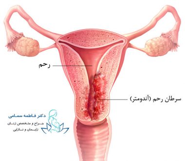 درمان عفونت رحم