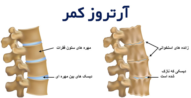 آرتروز کمر چیست