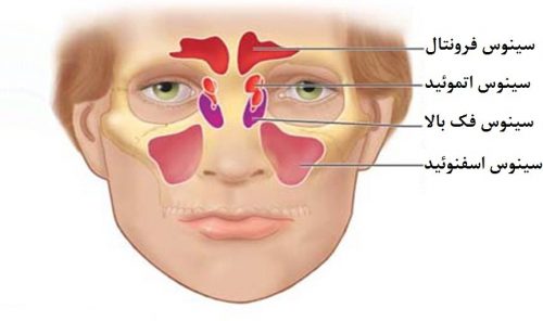 درمان سینوزیت