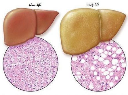 درمان خانگی کبد چرب