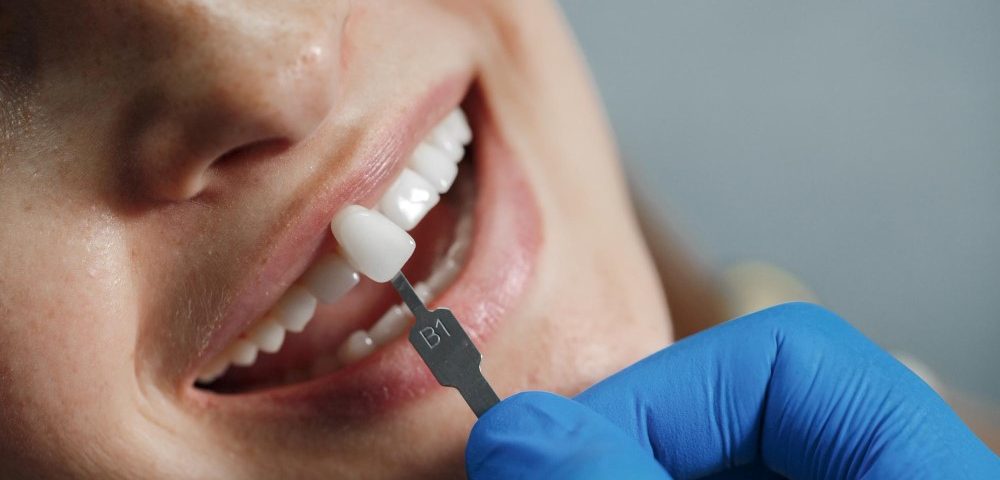 راهنمای ایمپلنت دندان