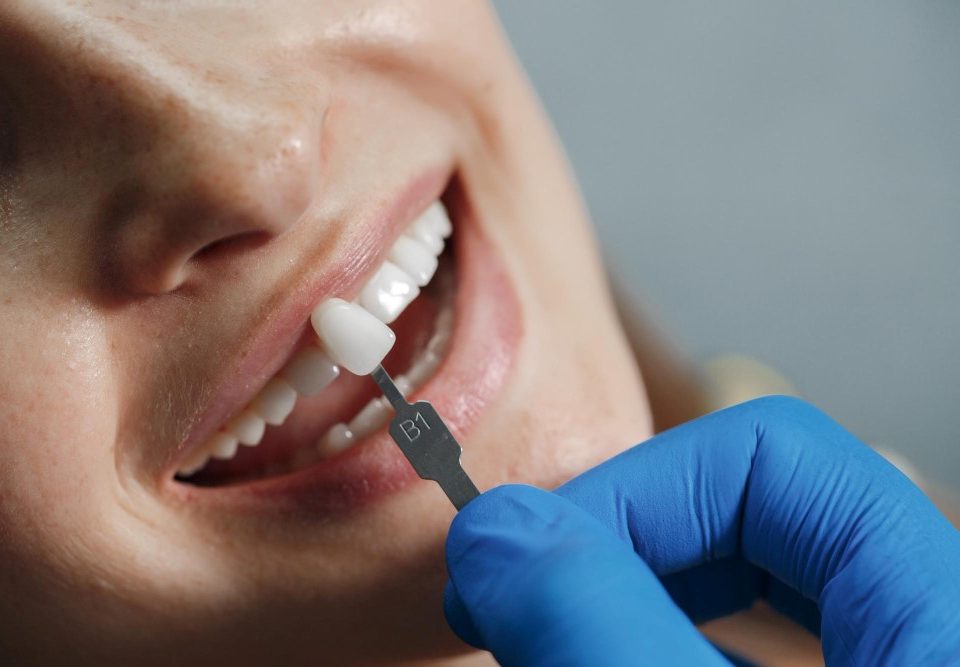 راهنمای ایمپلنت دندان